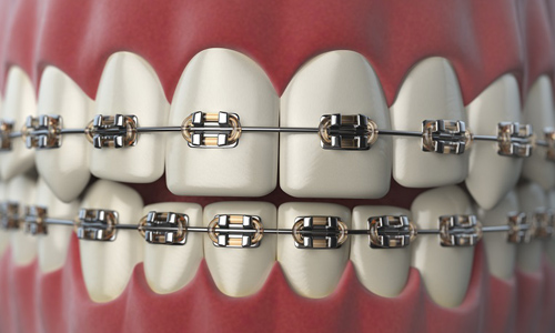 Misaligned Teeth