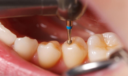 Dental Filling